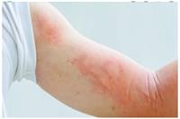 Biện pháp khắc phục khi trẻ nổi mề đay