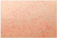 Nổi mẩn đỏ ngứa khắp người như muỗi đốt là bị gì? Cách chữa hiệu quả