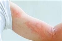 Điểm danh 5 dấu hiệu của bệnh sốt xuất huyết dễ nhận biết nhất