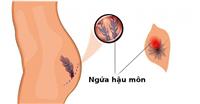 Ngứa hậu môn và nguyên nhân gây ngứa hậu môn