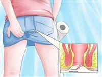 Ngứa hậu môn, cách thức điều trị