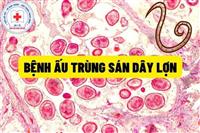 Bệnh ấu trùng sán dây lợn : Hướng dẫn chẩn đoán, điều trị và phòng bệnh