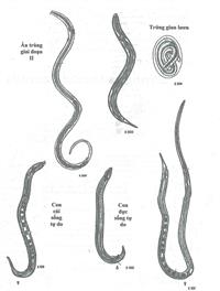 Bệnh giun lươn Strongyloides Stercoralis