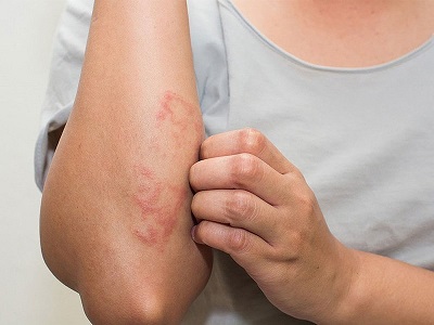 Nhiễm ký sinh trùng: Nguyên do, dấu hiệu, chẩn đoán và điều trị
