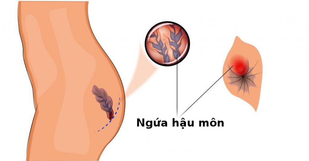 ngứa hậu môn do giun kim