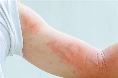 Ngứa thường xuyên, canh chừng bị nhiễm sán chó