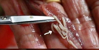 Nhiễm ký sinh trùng: Nguyên do, dấu hiệu, chẩn đoán và điều trị