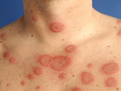 bị ngứa toàn thân vào ban đêm