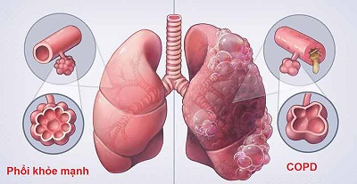 Sút cân không rõ nguyên nhân: Bạn nên chú ý