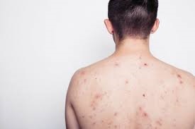bị ngứa toàn thân vào ban đêm