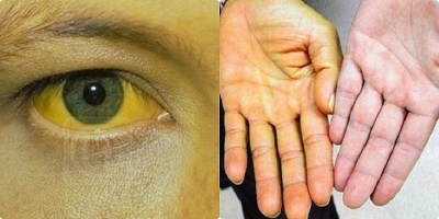 Vàng da ở người lớn thường can hệ đến những bệnh nào