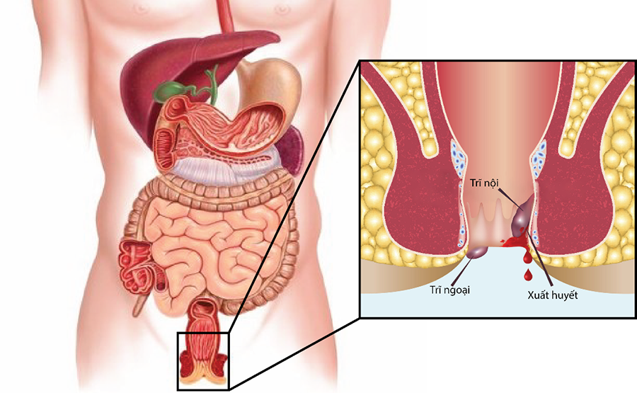 15 nguyên do chính dẫn đến tình trạng ngứa hậu môn.