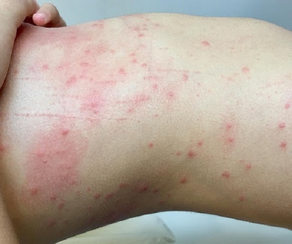 Ngứa toàn thân là tín hiệu của bệnh gì? Phương pháp xử lý an toàn.