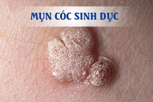 15 nguyên do gây ngứa hậu môn.