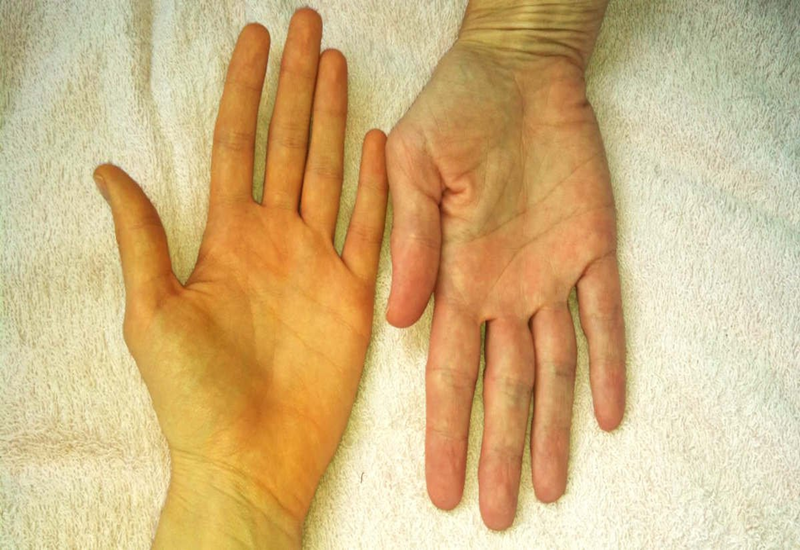 cách chữa bệnh vàng da ở người lớn