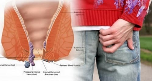 Triệu chứng ngứa vùng hậu môn vào buổi sáng