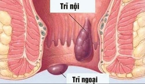 Triệu chứng ngứa vùng hậu môn vào buổi sáng