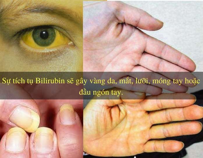 cách chữa bệnh vàng da ở người lớn
