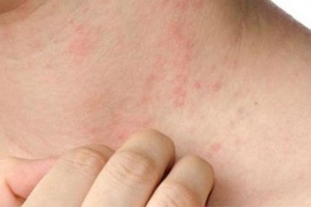 Ngứa toàn thân là tín hiệu của bệnh gì? Phương pháp xử lý an toàn.