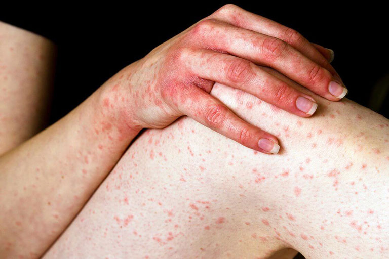 Dị ứng da ngứa toàn thân thì phải làm sao?