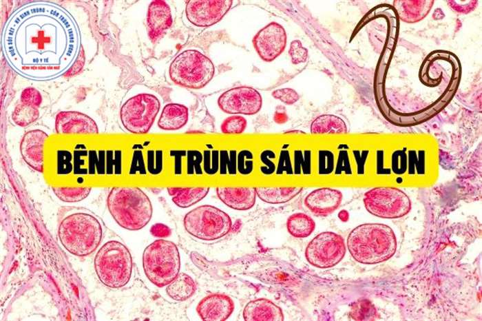 Bệnh ấu trùng sán dây lợn : Hướng dẫn chẩn đoán, điều trị và phòng bệnh